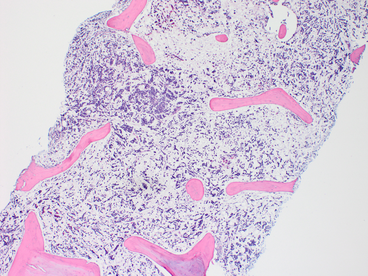Low power image of bone marrow biopsy section showing diffuse infiltrate of atypical cells in a background of myxoid-appearing stroma (x40, H&E)